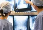 Novo protocolo de tratamento do câncer de pulmão propõe ampliar o acesso à cirurgia torácica assistida por vídeo para pacientes do sistema público de saúde (SUS)